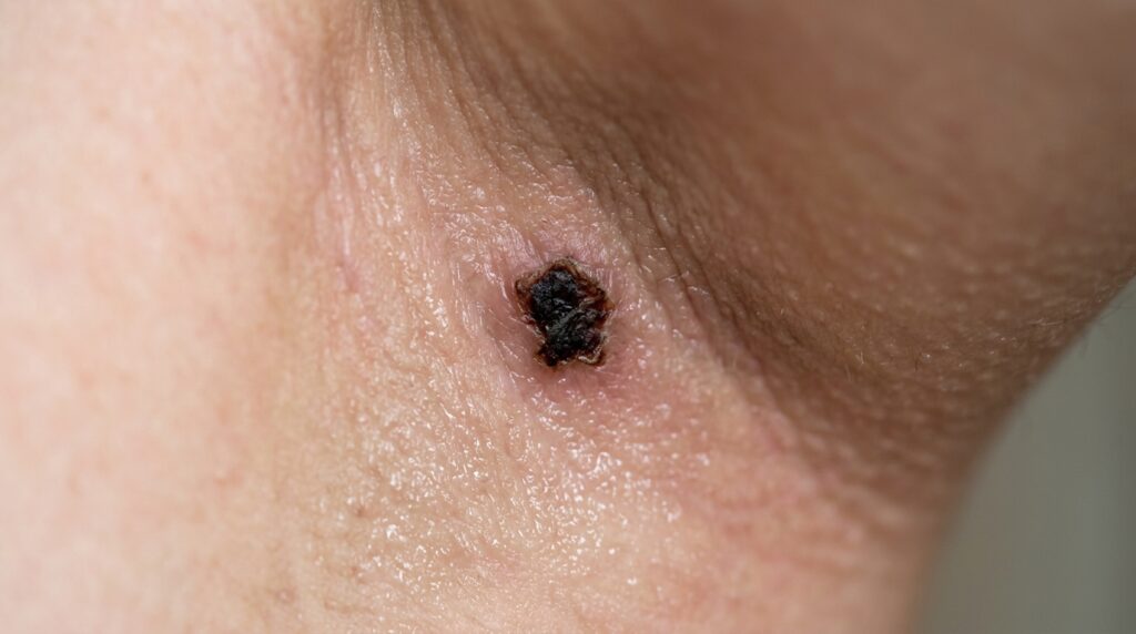 Image-of-hidden-black-eschar